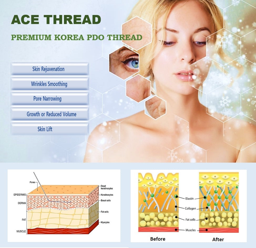 ACE PDO thread - 360R Bidirection Cog Cannula W type (40pcs)